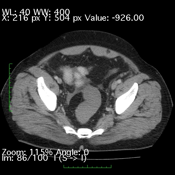 Acute pancreatitis (Radiopaedia 34043-35276 Axial C+ portal venous phase 86).jpg
