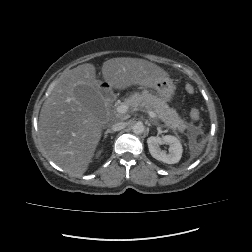 Acute pancreatitis (Radiopaedia 80007-93285 Axial C+ portal venous phase 53).jpg