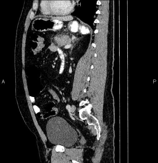 File:Acute pancreatitis (Radiopaedia 85390-101010 Sagittal C+ portal venous phase 63).jpg