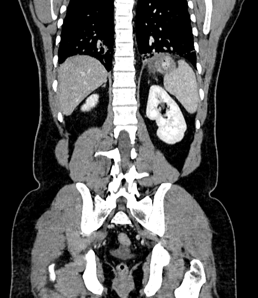 Acute pancreatitis (Radiopaedia 87428-103757 Coronal C+ portal venous phase 69).jpg