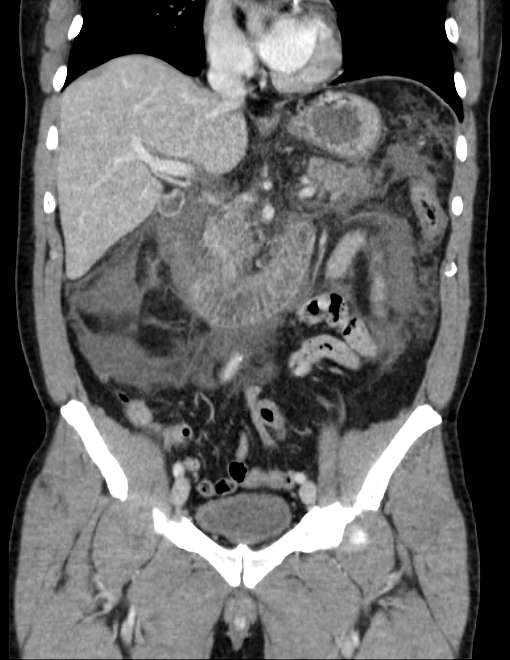 Acute pancreatitis - Balthazar E (Radiopaedia 23080-23110 Coronal C+ portal venous phase 38).jpg
