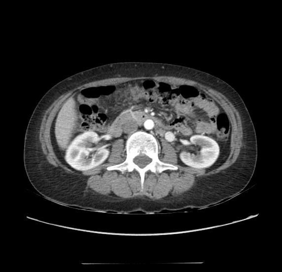 File:Acute pancreatitis - Balthazar E - post ERCP (Radiopaedia 27562-27772 Axial C+ arterial phase 28).png