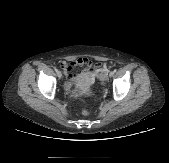 Acute pancreatitis - Balthazar E - post ERCP (Radiopaedia 27562-27772 Axial C+ portal venous phase 68).png