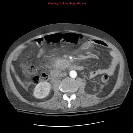 Acute pancreatitis with incidental pancreatic lipoma (Radiopaedia 10190-10730 Axial C+ arterial phase 53).jpg