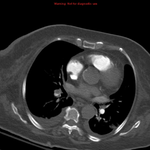 File:Acute pulmonary embolism (Radiopaedia 13286-13289 Axial C+ CTPA 36).jpg