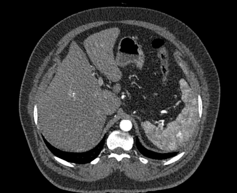Acute pulmonary embolism with pulmonary infarcts (Radiopaedia 77688-89908 Axial C+ CTPA 70).jpg