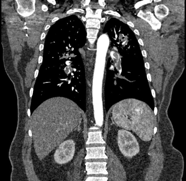 Acute pulmonary embolism with pulmonary infarcts (Radiopaedia 77688-89908 Coronal C+ CTPA 66).jpg