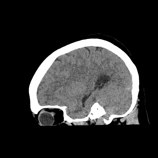 Acute subarachnoid hemorrhage and accessory anterior cerebral artery (Radiopaedia 69231-79008 Sagittal non-contrast 41).jpg