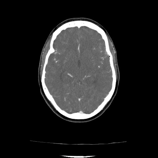 File:Acute subarachnoid hemorrhage and accessory anterior cerebral artery (Radiopaedia 69231-79009 Axial C+ arterial phase 95).jpg