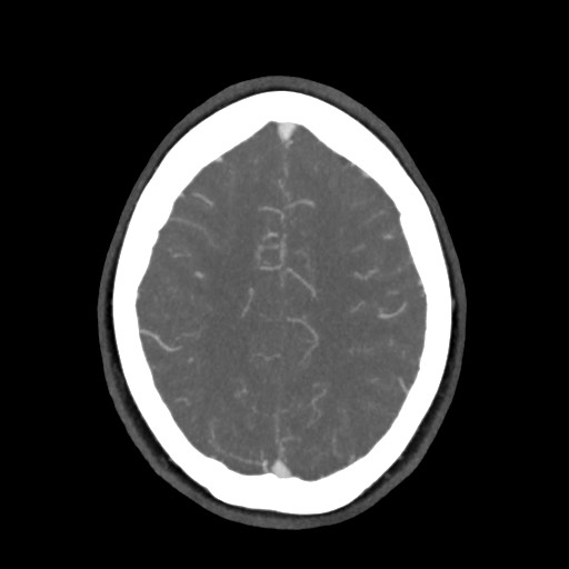 Acute subarachnoid hemorrhage and accessory anterior cerebral artery (Radiopaedia 69231-79009 D 53).jpg