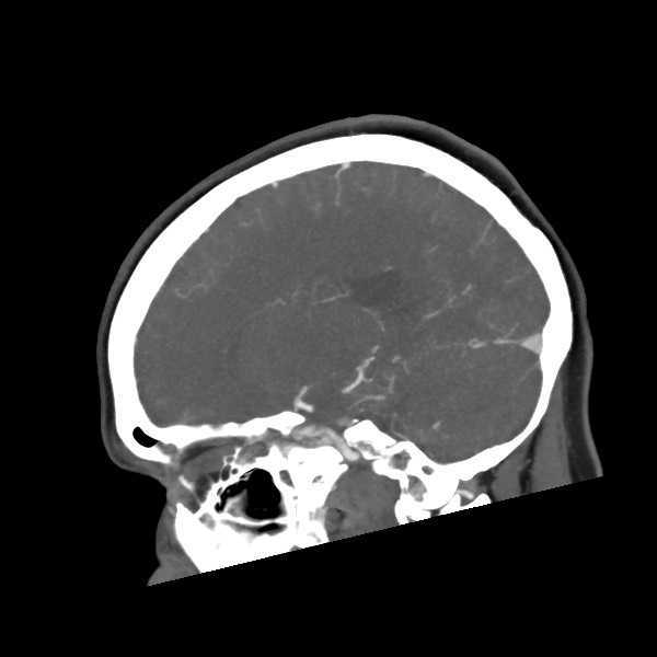 File:Acute subarachnoid hemorrhage and accessory anterior cerebral artery (Radiopaedia 69231-79009 Sagittal C+ arterial phase 45).jpg