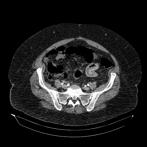 File:Acute superior mesenteric artery occlusion (Radiopaedia 51288-56960 Axial C+ arterial phase 70).jpg