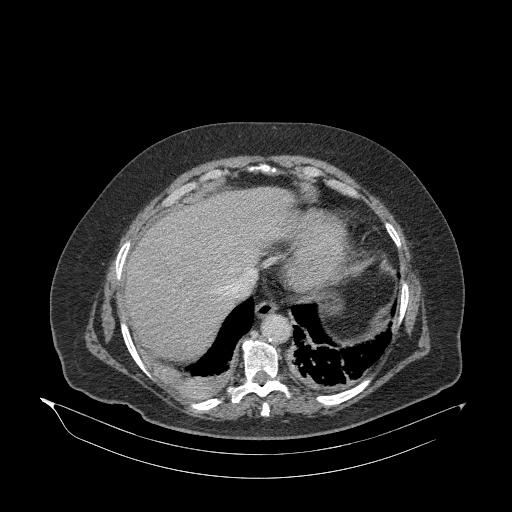 File:Acute superior mesenteric artery occlusion (Radiopaedia 51288-56960 Axial C+ portal venous phase 11).jpg