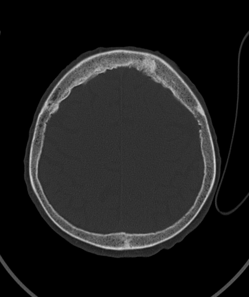 Acute traumatic subdural hematoma (Radiopaedia 82921-97257 Axial bone window 33).jpg
