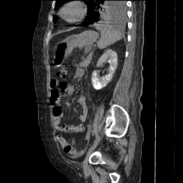 Acute tubular necrosis (Radiopaedia 28077-28334 Sagittal non-contrast 61).jpg