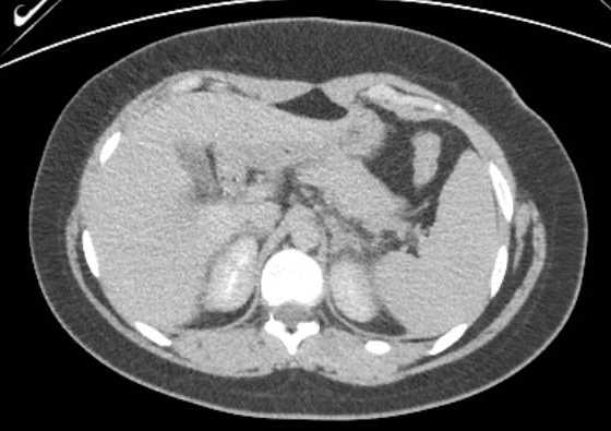 Acute unilateral nonhemorrhagic adrenal infarction (Radiopaedia 67560-76957 Axial renal excretory phase 27).jpg