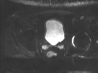 Adenocarcioma of rectum- T1 lesion (Radiopaedia 36921-38546 Axial DWI 14).png
