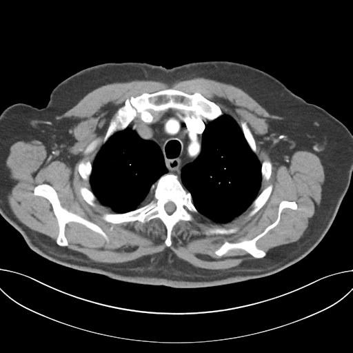 Adenocarcioma of rectum- T1 lesion (Radiopaedia 36921-38547 Axial C+ arterial phase 14).png