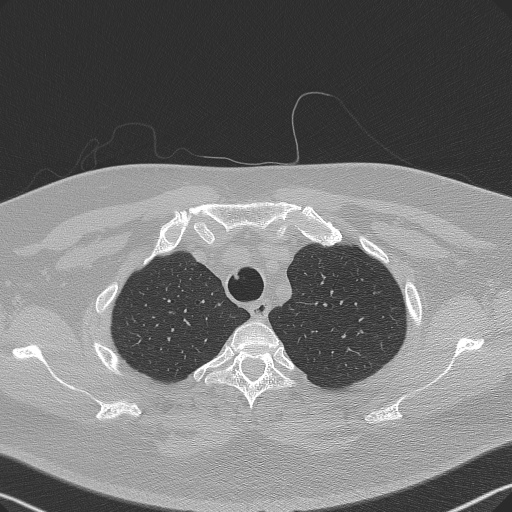 Adenoid cystic carcinoma of the trachea (Radiopaedia 49042-54137 Axial lung window 61).jpg