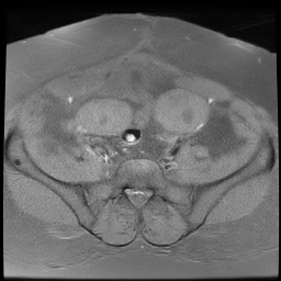 File:Adenomyosis within a didelphys uterus (Radiopaedia 70175-80215 Axial T1 fat sat 17).jpg