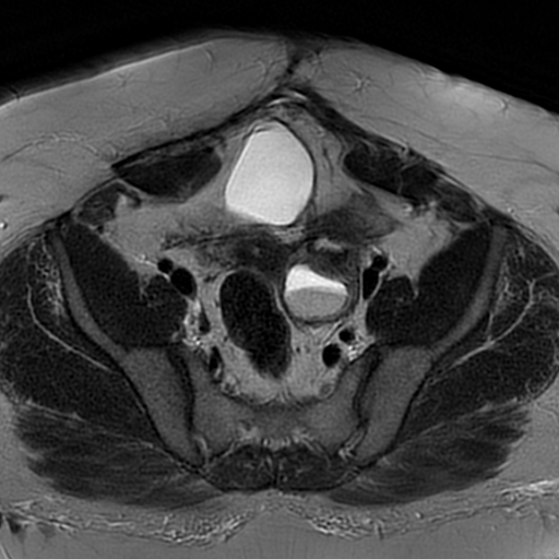File:Adenomyosis within a didelphys uterus (Radiopaedia 70175-80215 Axial T2 14).jpg