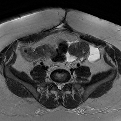 File:Adenomyosis within a didelphys uterus (Radiopaedia 70175-80215 Axial T2 7).jpg