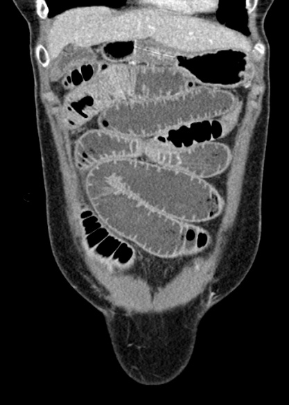 Adhesional small bowel obstruction (Radiopaedia 48397-53305 Coronal C+ portal venous phase 74).jpg
