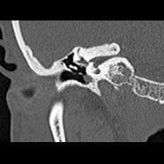 File:Adhesive chronic otitis media (Radiopaedia 14270-14148 Coronal bone window - right 9).jpg