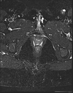 File:Adnexal multilocular cyst (O-RADS US 3- O-RADS MRI 3) (Radiopaedia 87426-103754 Axial T2 fat sat 25).jpg