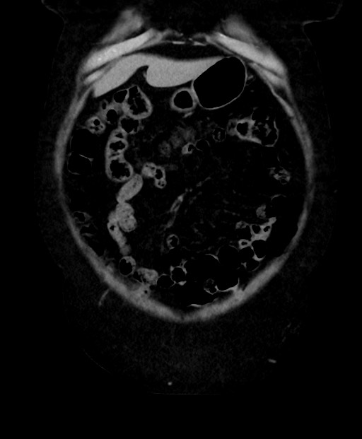 Adrenal cortical carcinoma (Radiopaedia 64017-72769 Coronal C+ delayed 14).jpg