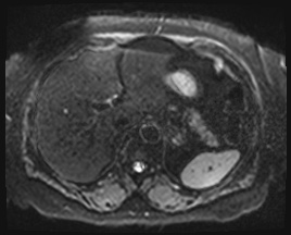 Adrenal cortical carcinoma (Radiopaedia 64017-72770 Axial DWI 8).jpg