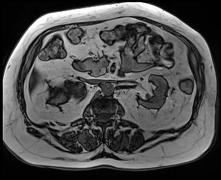 File:Adrenal cortical carcinoma (Radiopaedia 64017-72770 Axial T1 out-of-phase 38).jpg