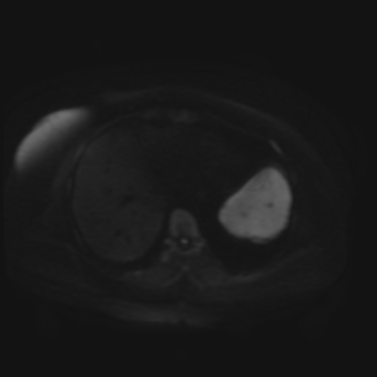 Adrenal cortical carcinoma (Radiopaedia 70906-81116 Axial DWI 33).jpg