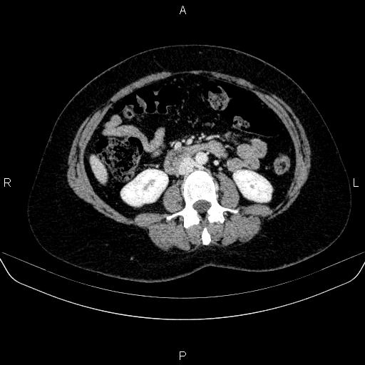Adrenal cortical carcinoma (Radiopaedia 84882-100379 Axial C+ portal venous phase 45).jpg