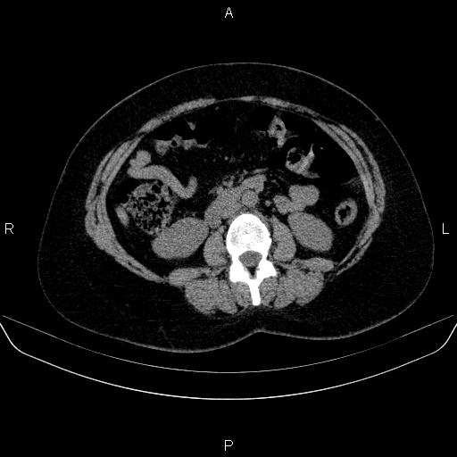 File:Adrenal cortical carcinoma (Radiopaedia 84882-100379 Axial non-contrast 44).jpg
