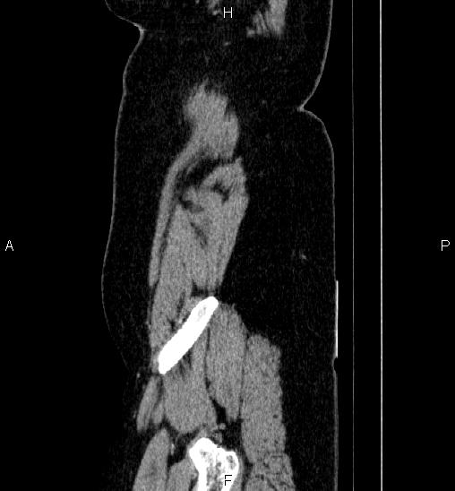 Adrenal cortical carcinoma (Radiopaedia 84882-100379 Sagittal C+ portal venous phase 5).jpg