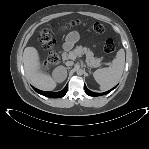 Adrenal cyst (Radiopaedia 45625-49778 Axial non-contrast 30).png