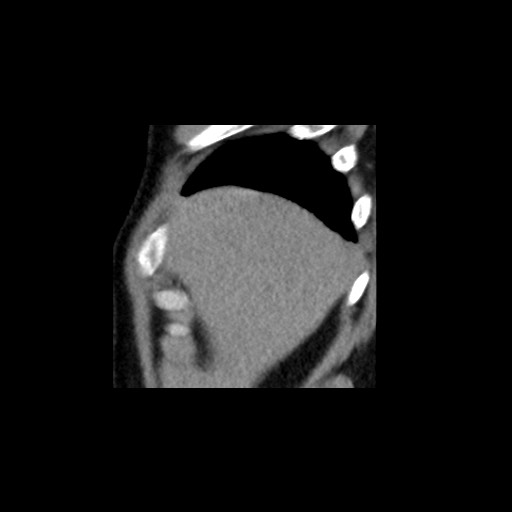 Adrenal gland trauma (Radiopaedia 81351-95079 Sagittal non-contrast 9).jpg