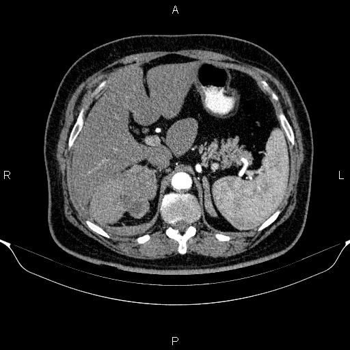 Adrenal hemorrhage (Radiopaedia 62622-70916 Axial C+ arterial phase 98).jpg