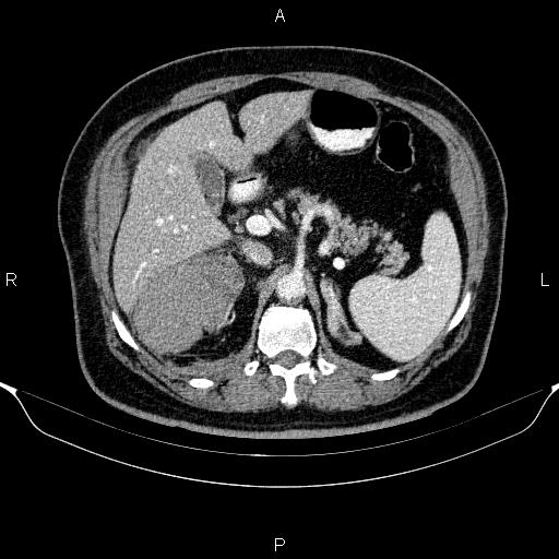 Adrenal hemorrhage (Radiopaedia 62622-70916 Axial C+ portal venous phase 55).jpg