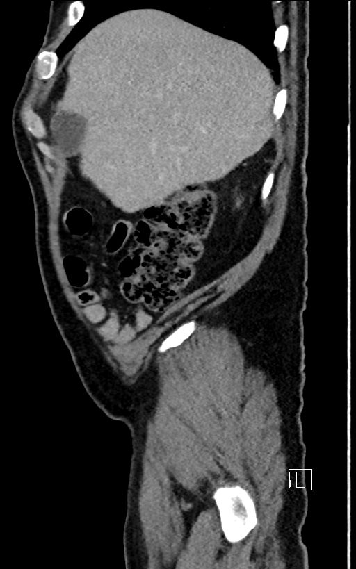 Adrenal lymphoma (Radiopaedia 73730-84529 Sagittal C+ portal venous phase 16).jpg