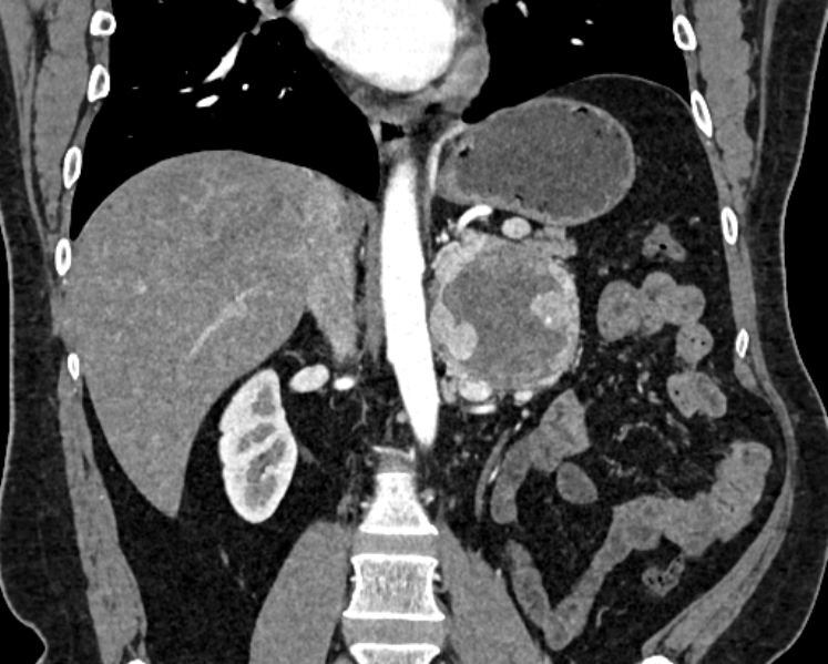 File:Adrenal metastases (Radiopaedia 73082-83791 Coronal C+ arterial phase 29).jpg