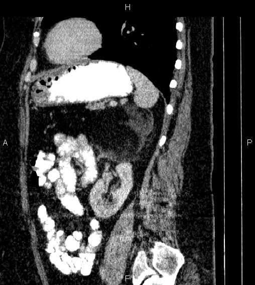 Adrenal myelolipoma (Radiopaedia 84319-99617 Sagittal renal cortical phase 67).jpg