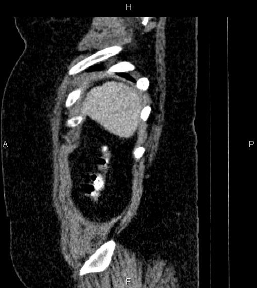 Adrenal myelolipoma (Radiopaedia 84319-99617 Sagittal renal cortical phase 91).jpg