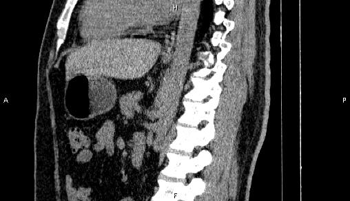 Adrenal myelolipoma (Radiopaedia 84321-99619 Sagittal non-contrast 60).jpg