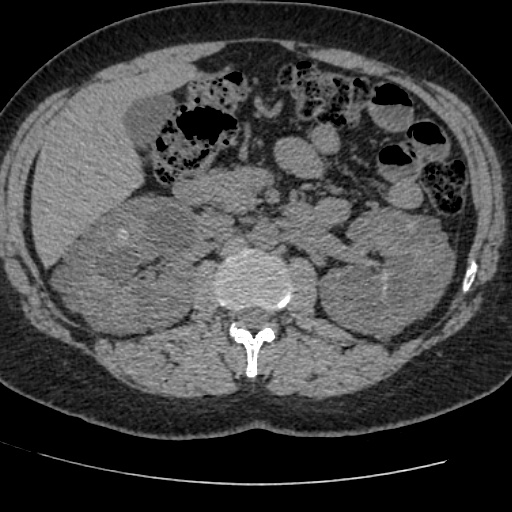 Adult polycystic kidney disease (Radiopaedia 59075-66368 Axial non-contrast 29).jpg
