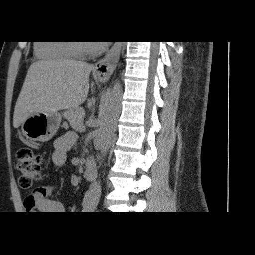 Adult polycystic kidney disease (Radiopaedia 59075-66368 Sagittal non-contrast 46).jpg