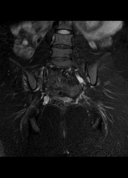 File:Aggressive angiomyxoma of the pelvis and perineum (Radiopaedia 59162-66479 Coronal T2 fat sat 20).jpg