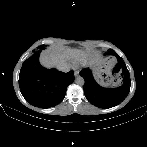 Air bronchogram in pneumonia (Radiopaedia 85719-101512 Axial non-contrast 55).jpg