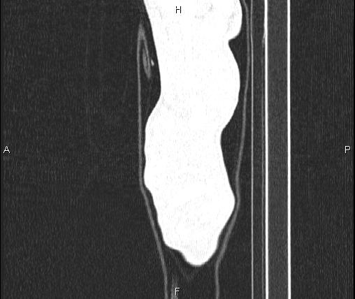 File:Air bronchogram in pneumonia (Radiopaedia 85719-101512 Sagittal lung window 2).jpg
